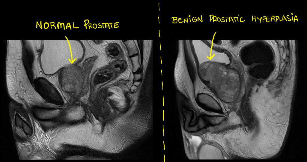 Normal prostate vs. benign prostatic hyperplasia