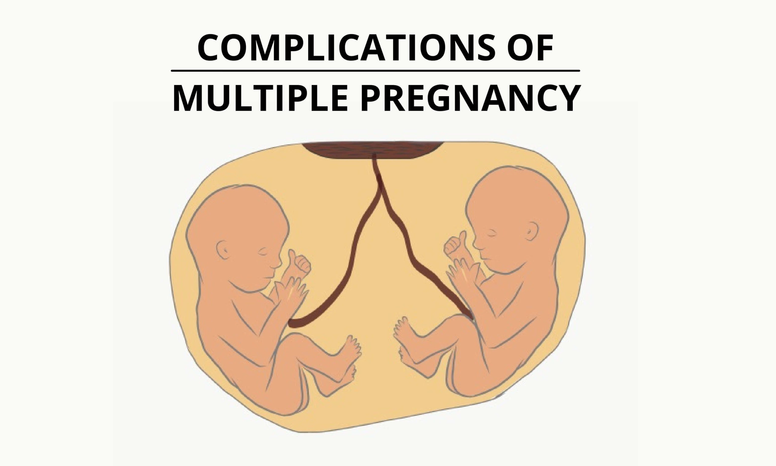 case study on multiple pregnancy