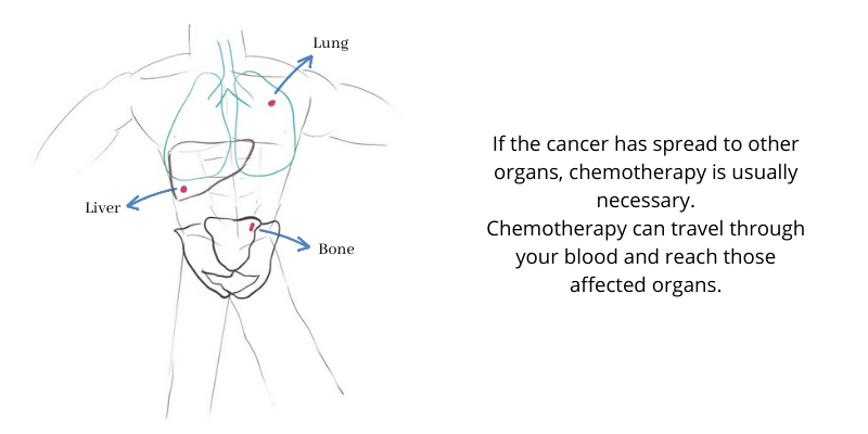 Metastases in different organs: liver, lungs and bone