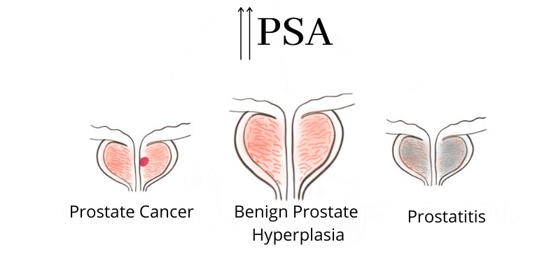 High PSA and causes