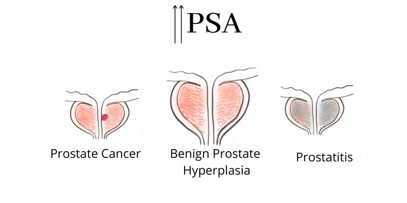 High PSA and causes