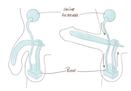 Penis implant: components and how it works