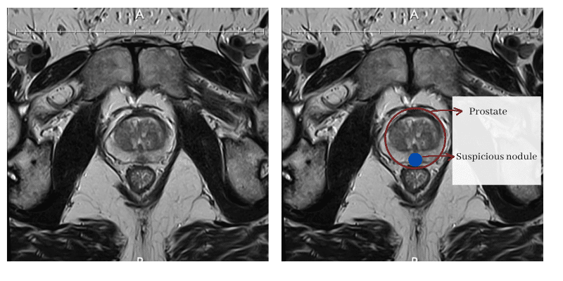 Prostate MRI with a suspicious nodule in the prostate