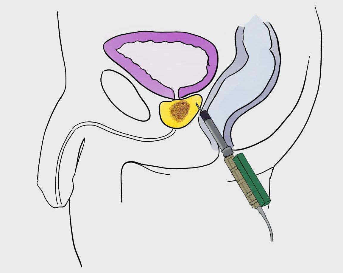 Trans-rectal prostate biopsy