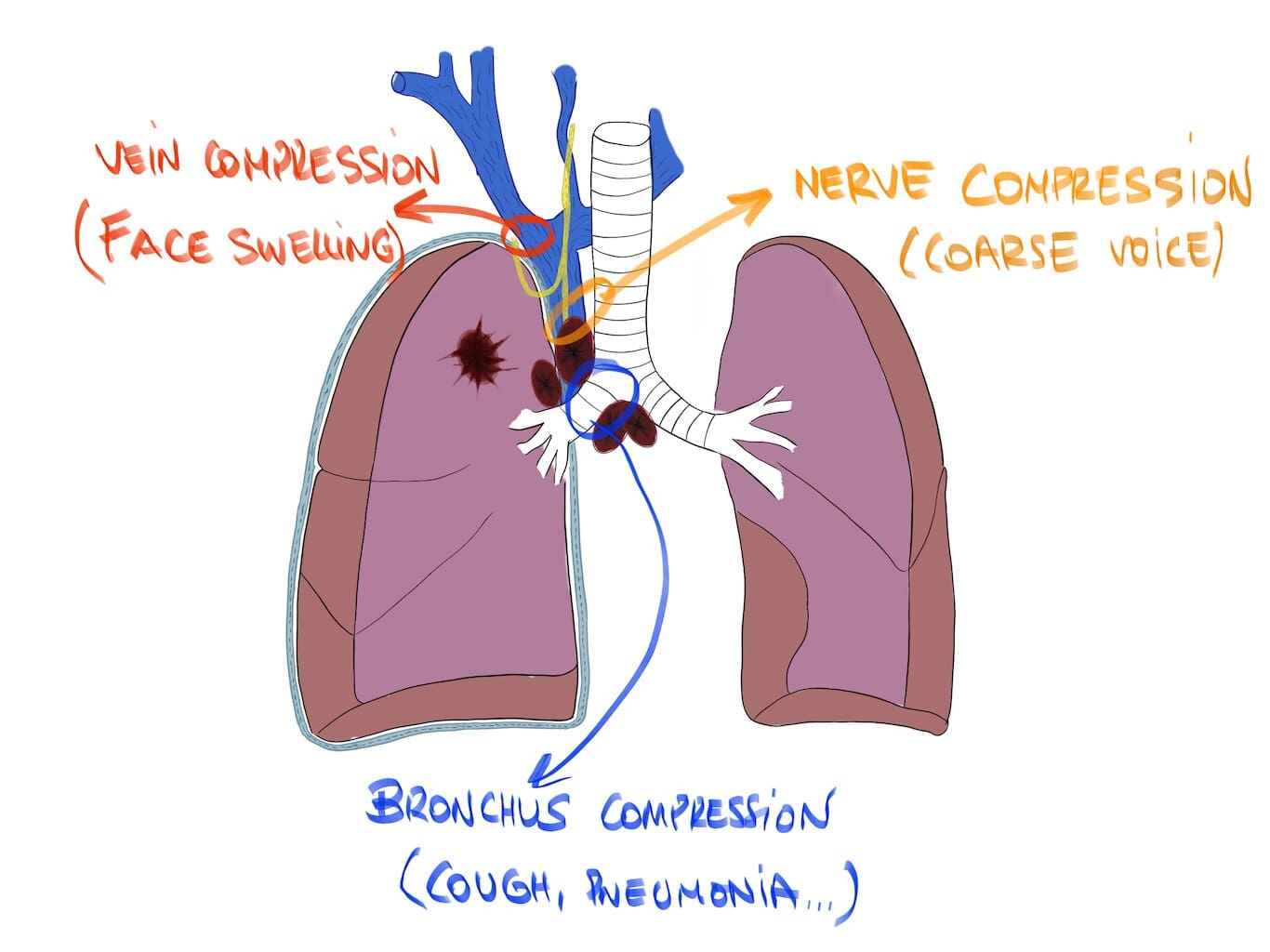 lung tumor compressing the nerve (coarse voice), the bronchus (cough and pneumonia) and the vein (face swelling)
