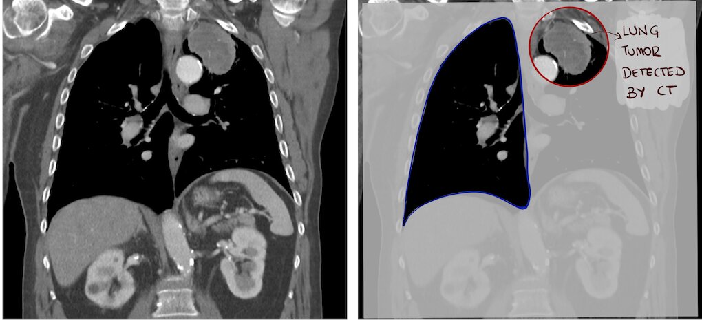 lung tumor detected by CT in the left lung