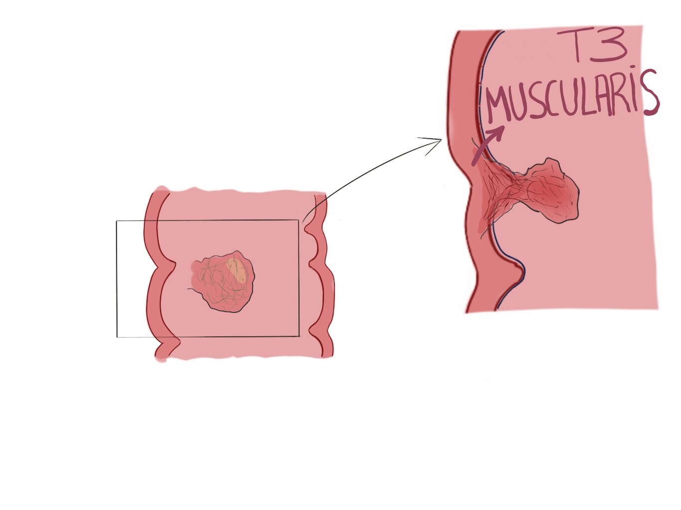 Colon cancer infiltrating the muscularis layer (T3 staging)