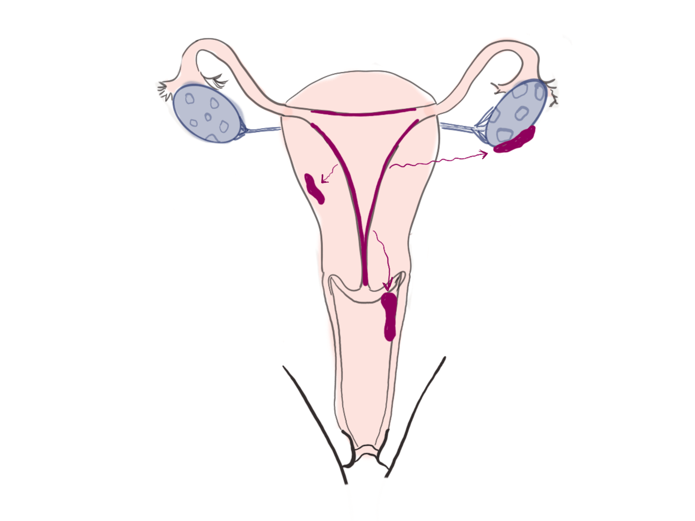 Endometriosis