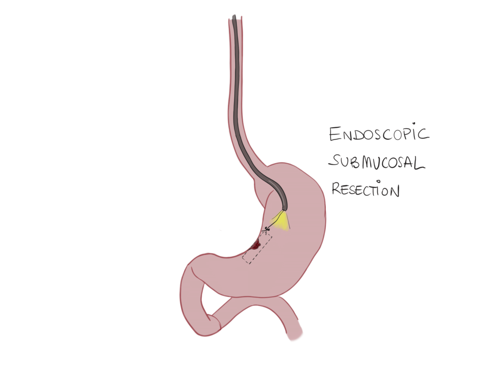 Endoscopic Submucosal Resection for Gastric Cancer