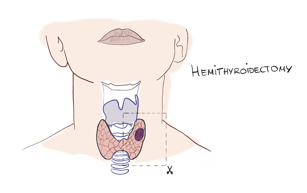 Hemithyroidectomy