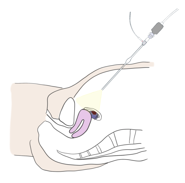 Laparoscopic biopsy