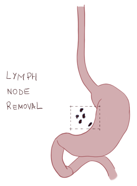 Lymphadenectomy