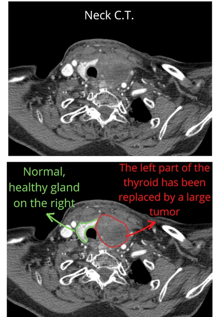 Neck C.T. with thyroid cancer