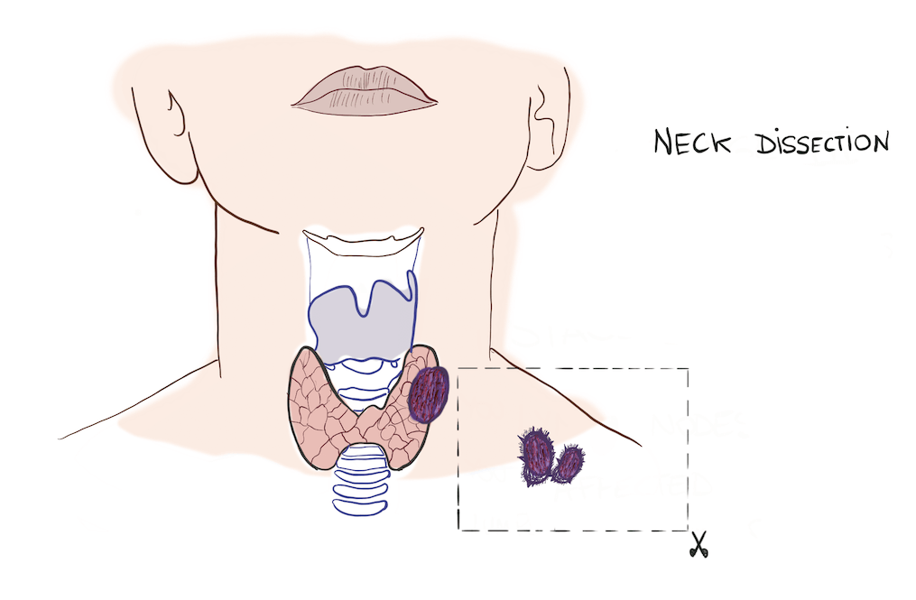Neck Dissection
