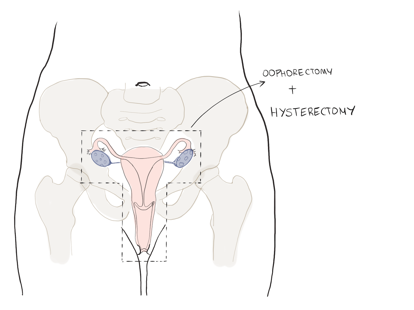 Oophorectomy and hysterectomy