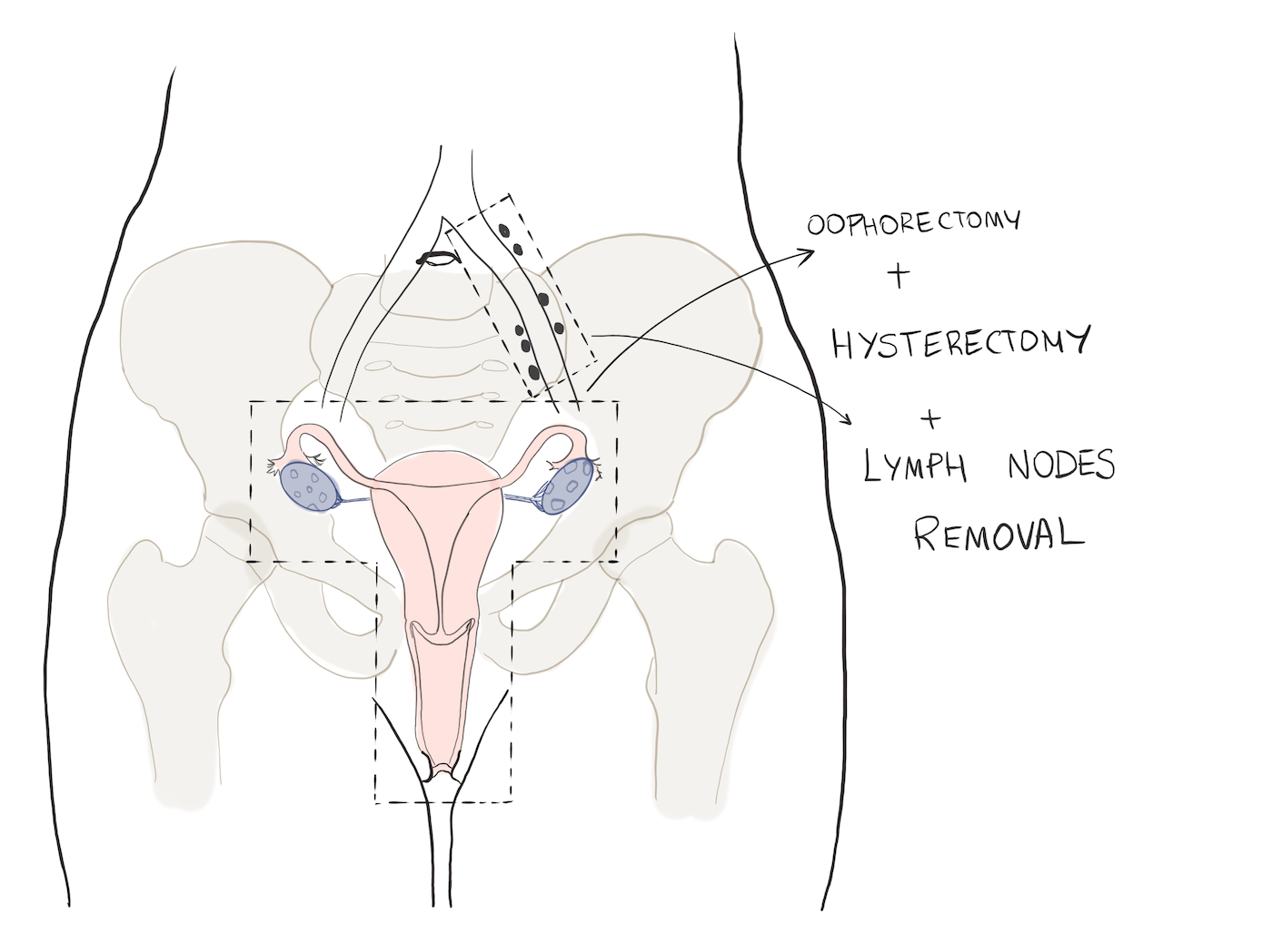 Oophorectomy and hysterectomy and lymph node resection