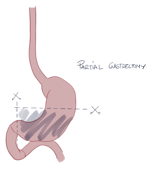 Partial Gastrectomy for Stomach Cancer