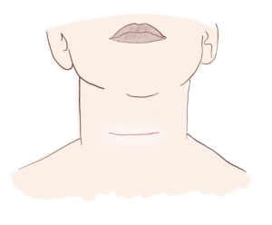 Thyroidectomy Scar