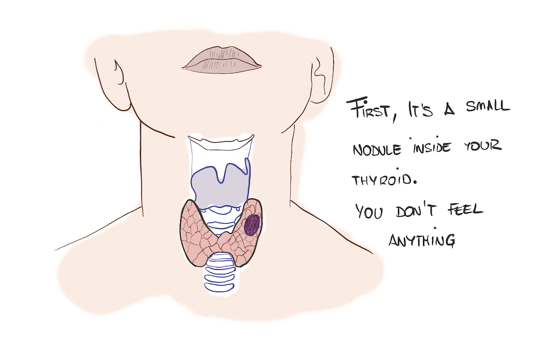 Thyroid Symptoms: silent nodule