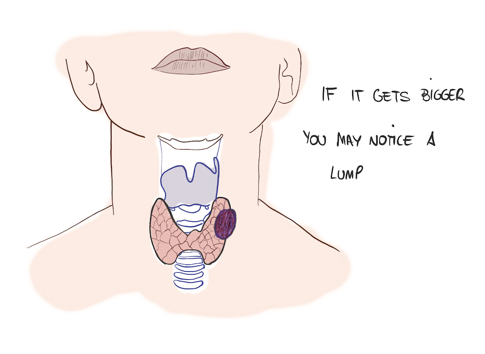 Thyroid nodule grown