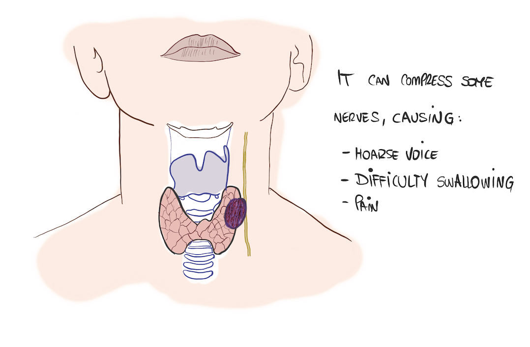 Thyroid nodule infiltrating other structures