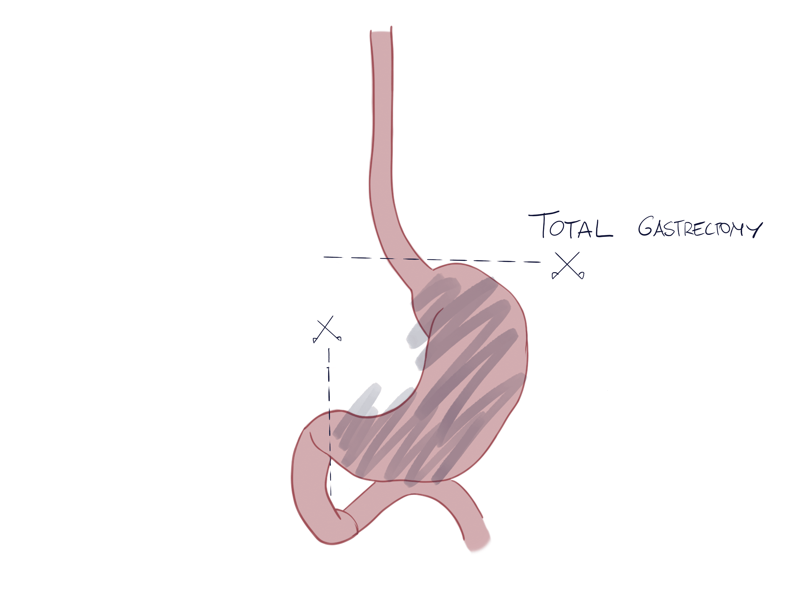 Total Gastrectomy for Gastric Cancer