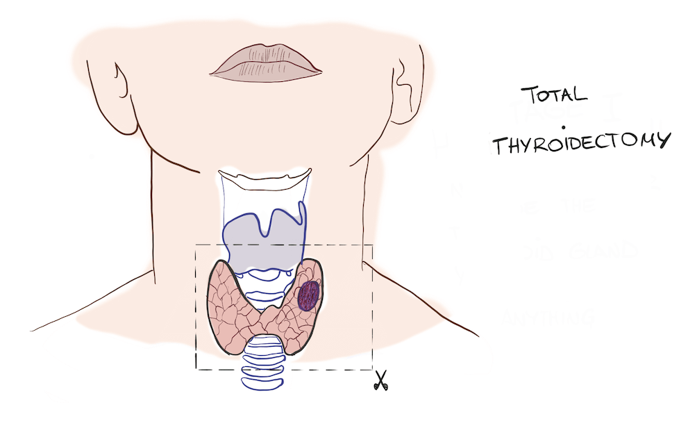 Total Thyroidectomy