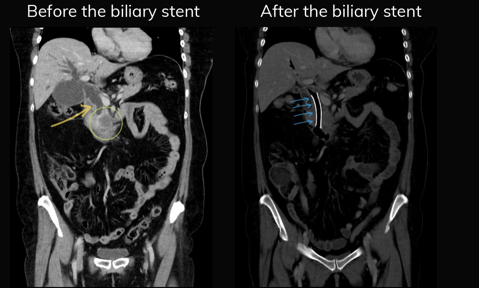 Biliary stent