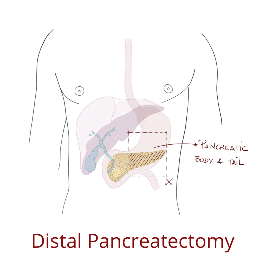 Distal pancreatectomy for pancreatic cancer