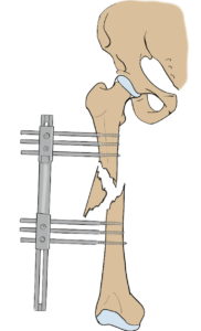 External fixation for femoral fracture