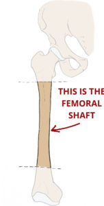 Femoral Shaft With Annotations