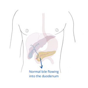 Jaundice Process Biliary Obstruction (GIF)