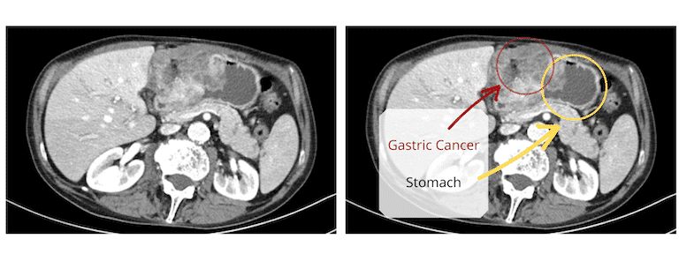 Abdominal CT showing a gastric tumor