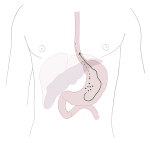 Gastroesophageal reflux