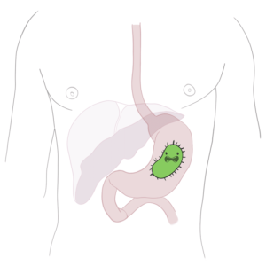 Helicobacter Pylori