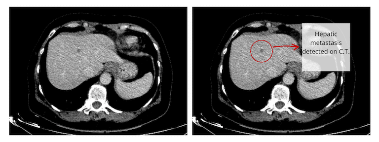 Hepatic metastasis on C.T.