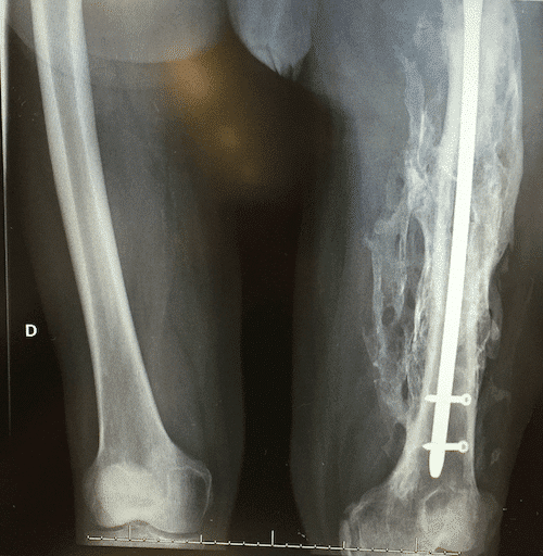 Heterotopic ossification