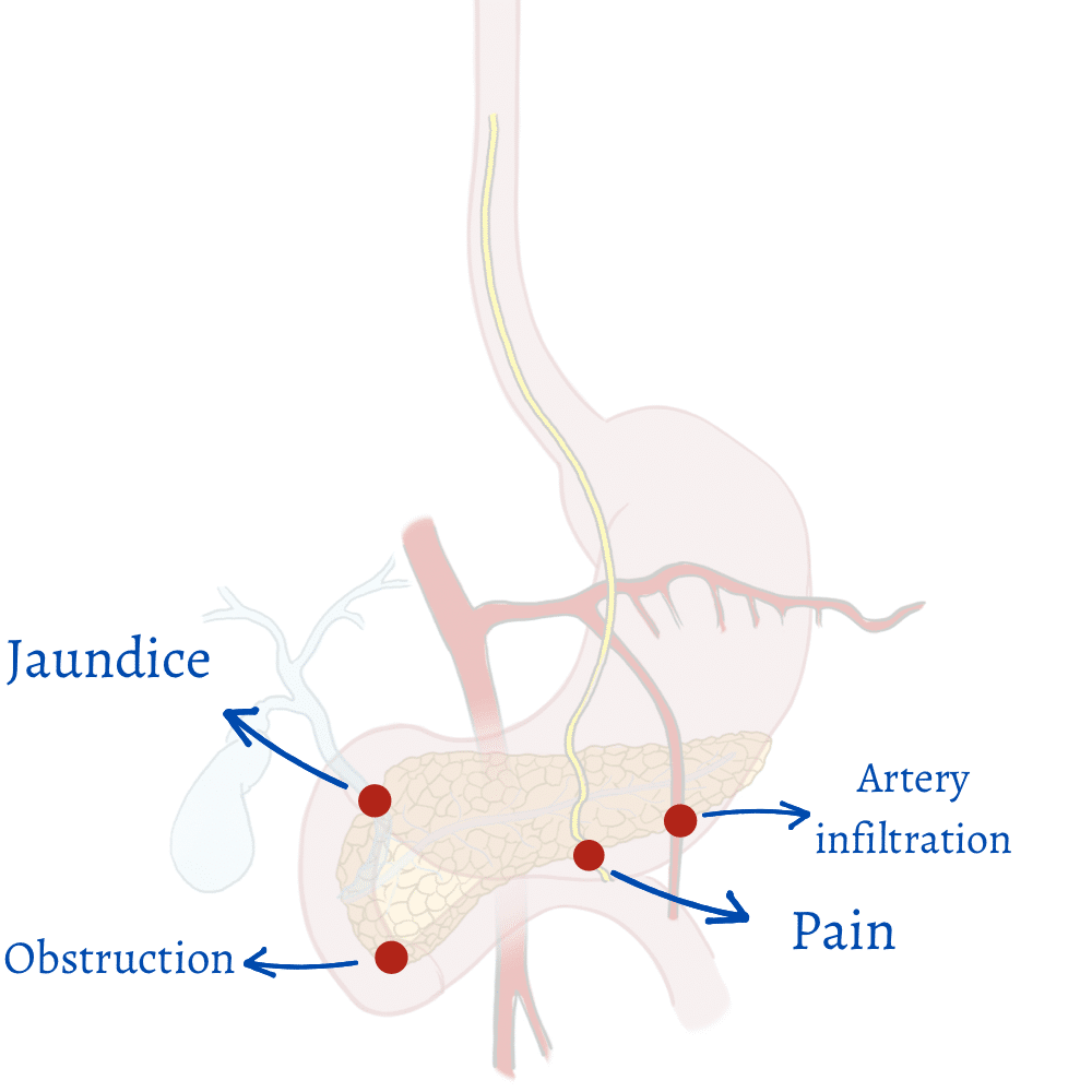 Pancreatic Cancer Symptoms according to location