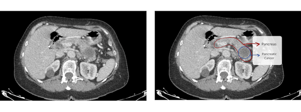 Prostate Cancer case - CT