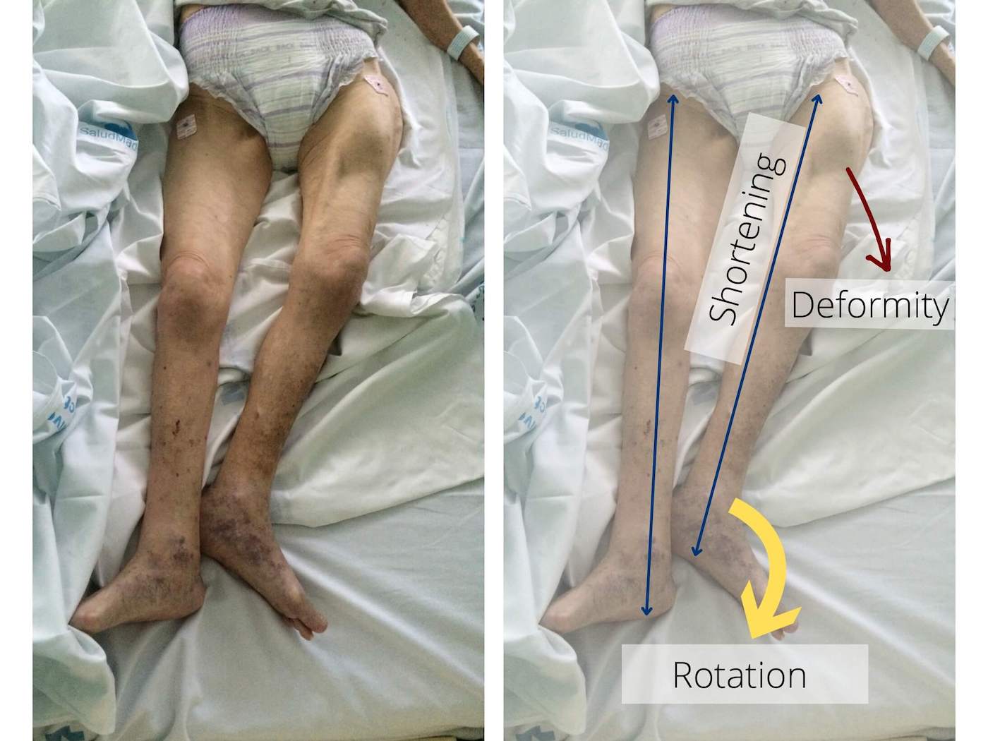 Patient with femoral neck fractured: his leg is shortened and with external rotation