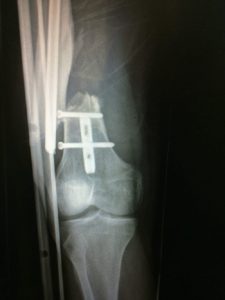 Peri-implant femoral fracture