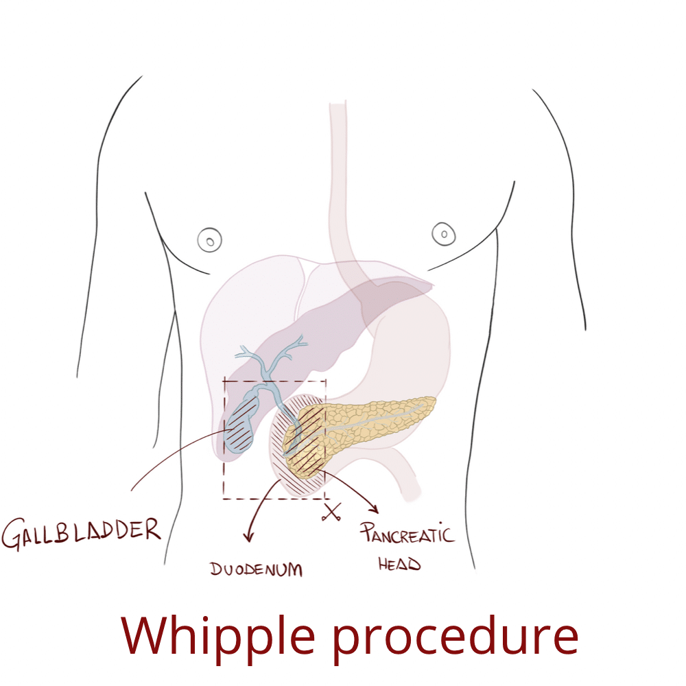 Whipple procedure for pancreatic cancer
