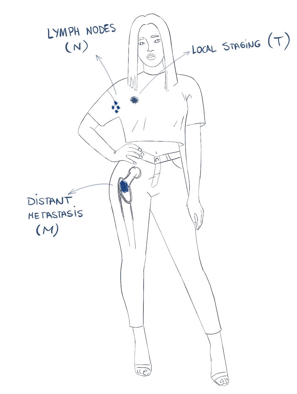 Breast Cancer Staging