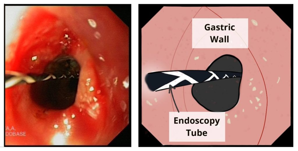 Endoscopy diagram