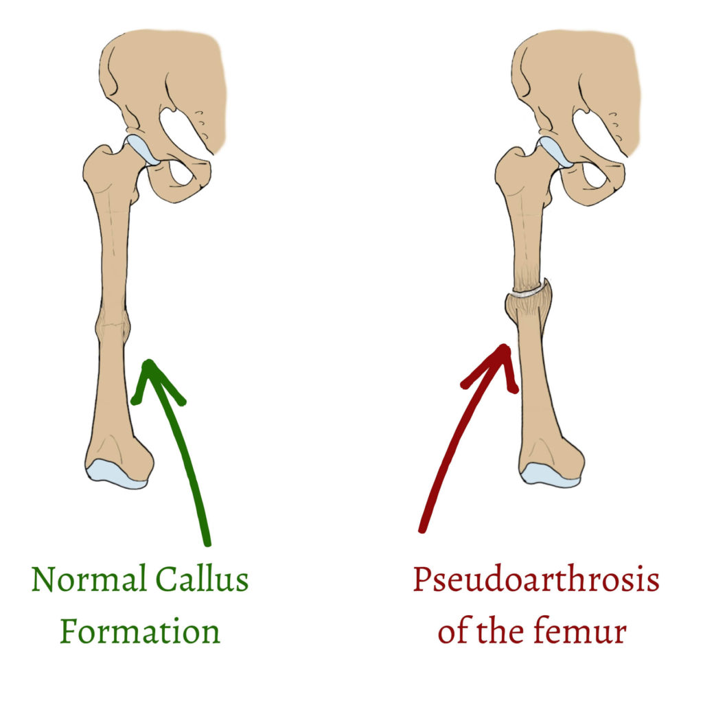 Normal callus formation vs pseudoarthrosis of the femur