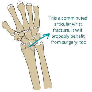 Comminuted wrist fracture