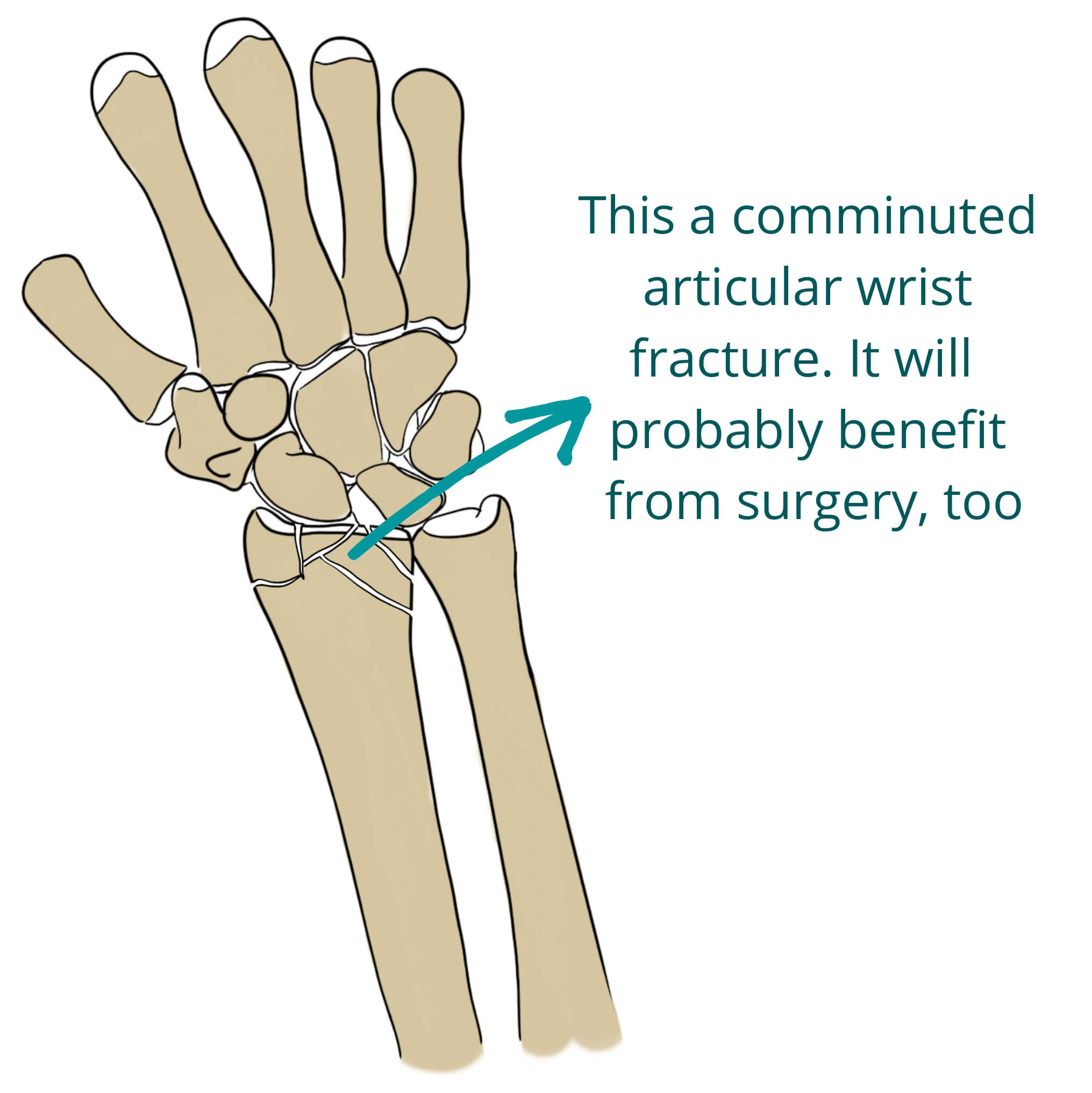 Wrist Fractures Distal Radius Fractures Pro Doctor