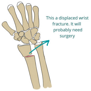 Displaced wrist fracture