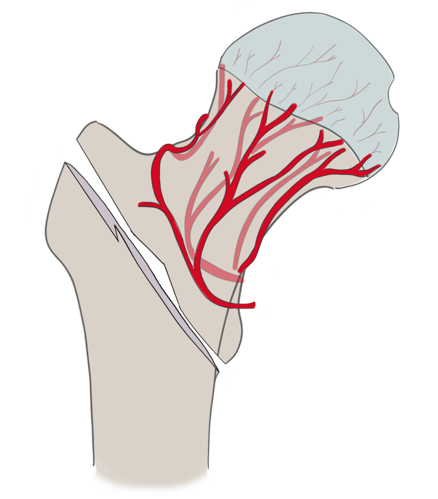 Extracapsular hip fracture