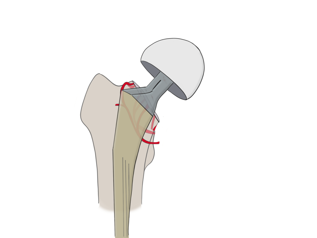 Hip replacement for intracapsular hip fracture
